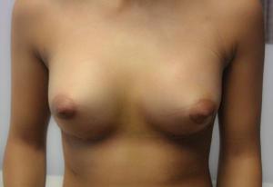 small breast post enhancement 300cc teardrop implants 2